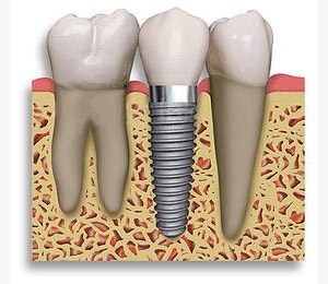 dental implant