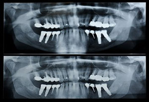 panoramic x-ray
